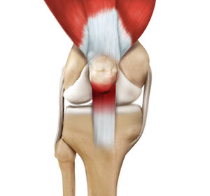 Patellar Tendonitis - Educational Picture