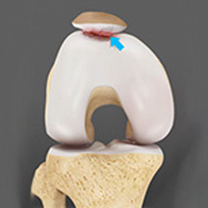 Patellofemoral Arthritis - Educational Picture