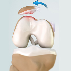 Patellofemoral Instability - Educational Picture
