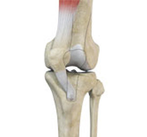 Patellofemoral Realignment - Educational Picture
