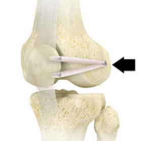 Patellofemoral Stabilization - Educational Picture