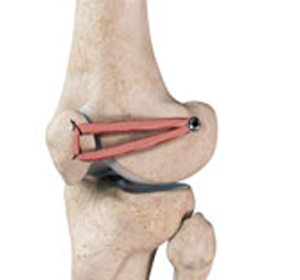 Patellofemoral Knee Replacement - Educational Picture