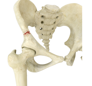 Pelvic Fractures - Educational Picture