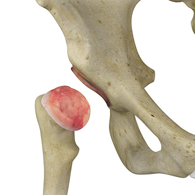 Post-Traumatic Hip Arthritis Treatment - Educational Picture