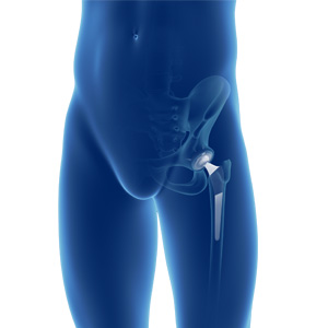 Primary Hip Replacement - Educational Picture
