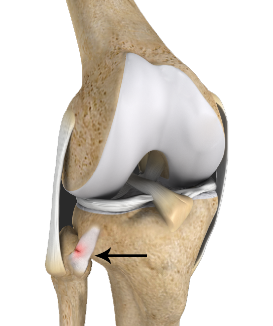 Proximal Tibiofibular Joint Instability - Educational Picture