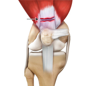 Quadriceps Tendon Rupture - Educational Picture