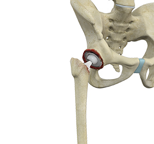Revision Hip Replacement - Educational Picture