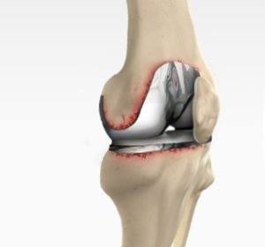Revision Knee Replacement - Educational Picture