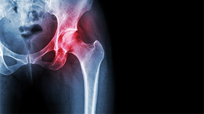 Rheumatoid Arthritis of the Hip - Educational Picture