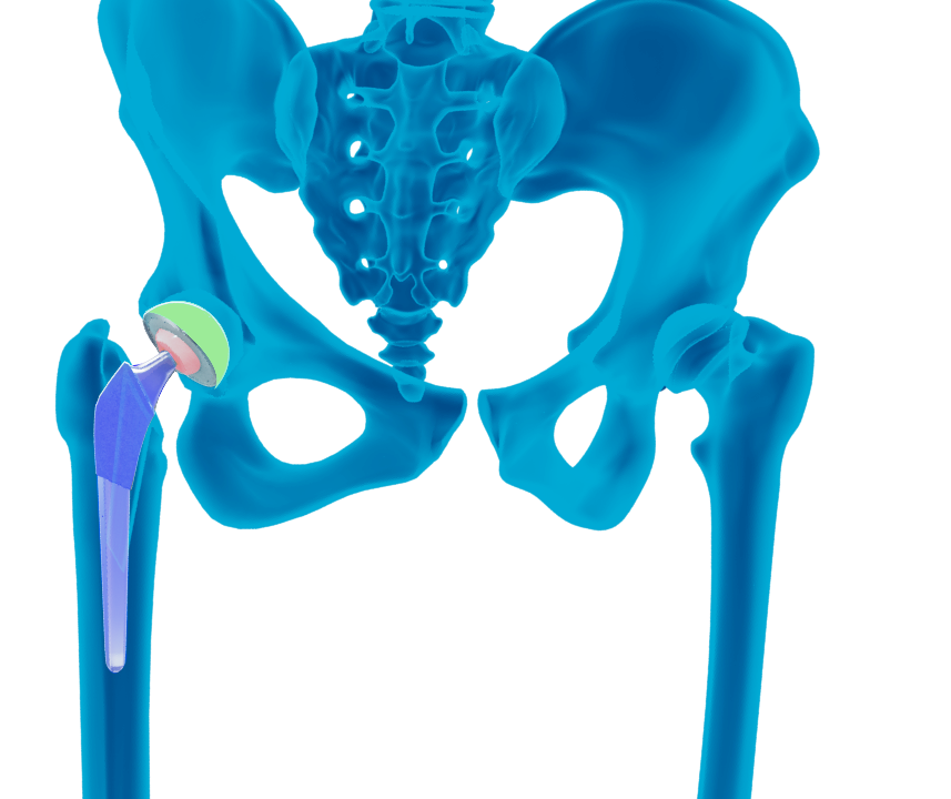 Robotic Anterior Total Hip Arthroplasty - Educational Picture