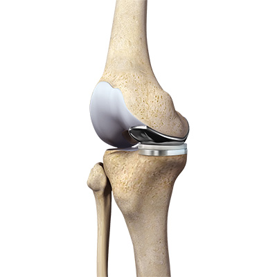 Robotic Assisted Partial Knee Surgery - Educational Picture