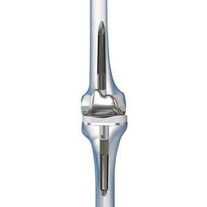 Robotic-Assisted Revision Knee Replacement - Educational Picture
