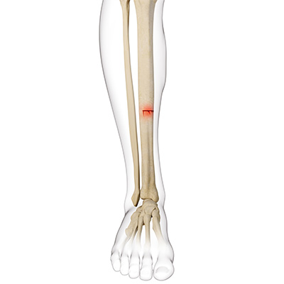 Stress Fracture of the Tibia - Educational Picture