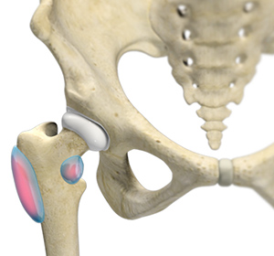 Trochanteric Bursectomy - Educational Picture