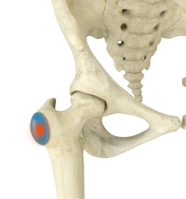 Trochanteric Bursitis - Educational Picture
