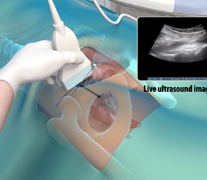 Ultrasound Guided Hip Injections - Educational Picture