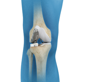 Unicompartmental/Partial Knee Replacement - Educational Picture