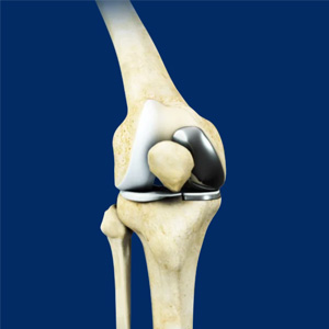 Unicondylar Knee Replacement - Educational Picture