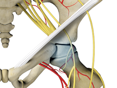 Avascular Necrosis - Educational Picture