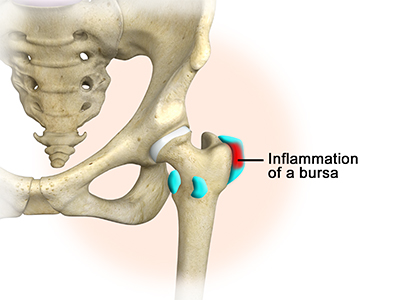 Hip Bursitis - Educational Picture