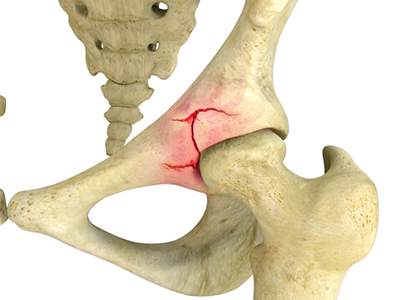 Hip Fracture - Educational Picture