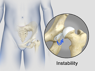 Hip Instability - Educational Picture