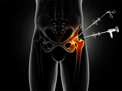 Hip Surgery - Educational Picture