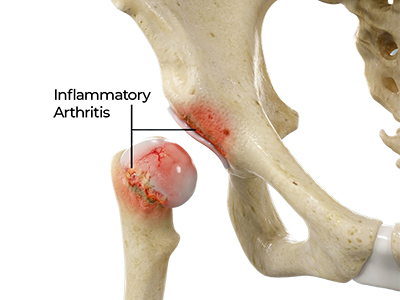 Inflammatory Arthritis of the Hip - Educational Picture