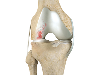 Knee Surgery - Educational Picture