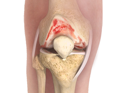 Knee Osteoarthritis - Educational Picture