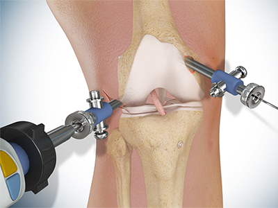 Knee Surgery - Educational Picture