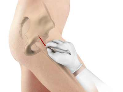 Minimally Invasive Total Hip Replacement - Educational Picture