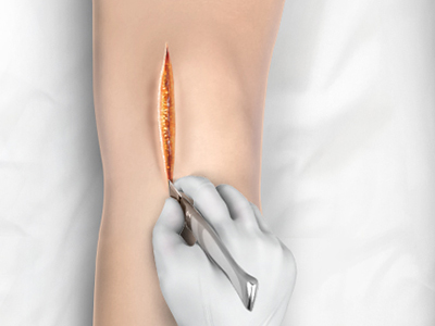Minimally Invasive Knee Joint Replacement - Educational Picture