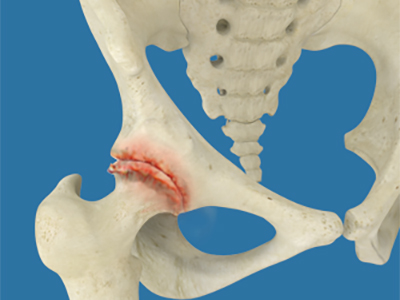 Osteoarthritis of the Hip - Educational Picture