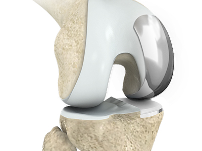 Unicompartmental/Partial Knee Replacement - Educational Picture