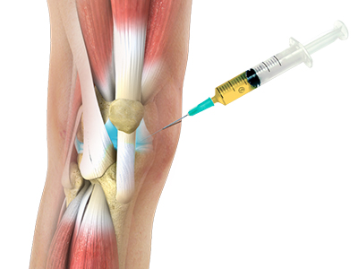 Platelet-Rich Plasma Injections - Educational Picture