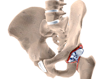 Revision Hip Replacement - Educational Picture