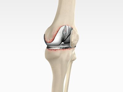Revision Knee Replacement - Educational Picture