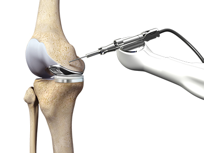 ROSA Robotic Total Knee Replacement - Educational Picture