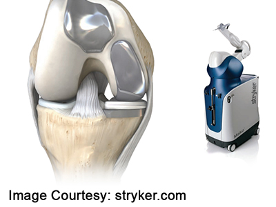 Robotic Assisted Partial Knee Surgery - Educational Picture
