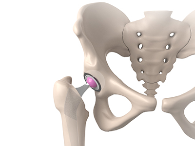 Same Day Hip Replacement - Educational Picture