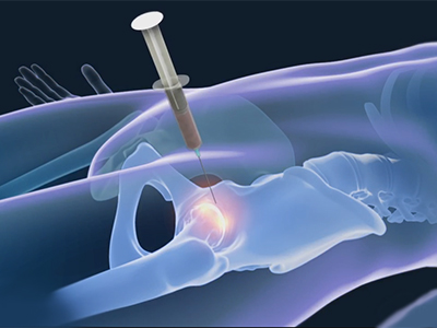 Stem Cell Therapy - Educational Picture