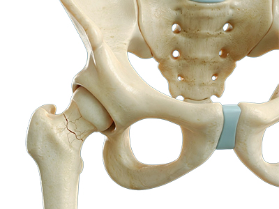 Stress Fractures of the Hip - Educational Picture