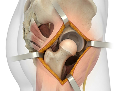 Surgical Dislocation of the Hip - Educational Picture