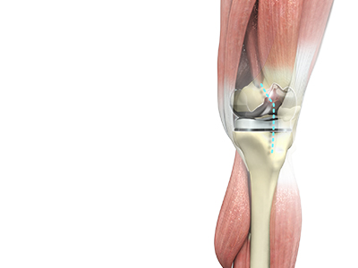 Total Knee Replacement - Educational Picture