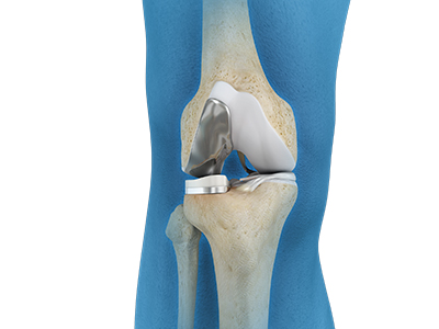 Partial Knee Replacement - Educational Picture