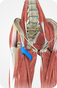 Anterior Hip Replacement