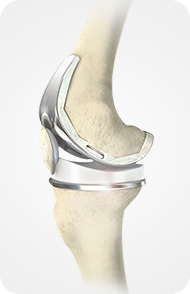 Cementless Knee Replacement