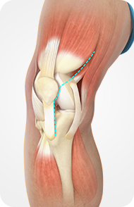Minimally Invasive Knee Replacement